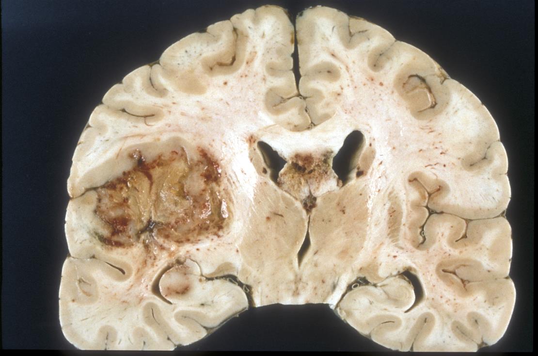 Glioblastoma Multiforme Treatment Market