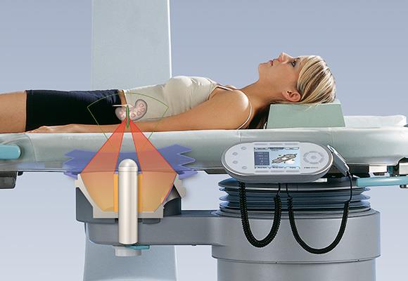 Chile Extracorporeal Shock Wave Lithotripsy Market